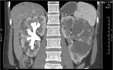CT-images-of-a-complete-staghorn-calculus-in-the-right-kidney-in-an-ADPKD-female-Above.png